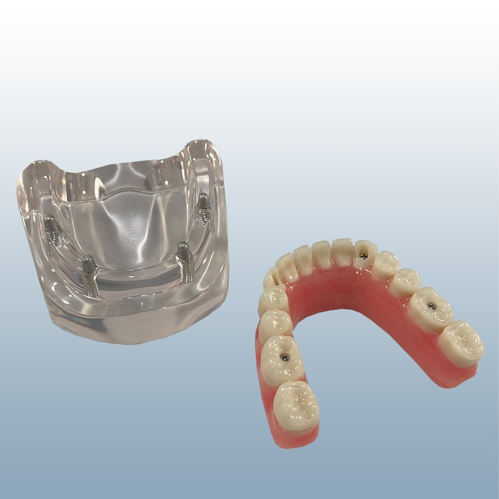 All on 4 Model with 30-degree Angled Posterior Implants on Mandibular Arch product image