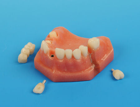 75 STI Implant Model product image