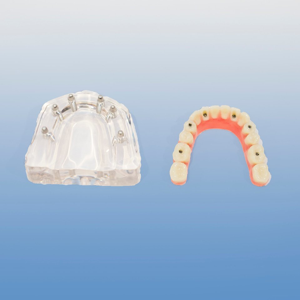 Hybrid Overdenture on 6 implants Model product image