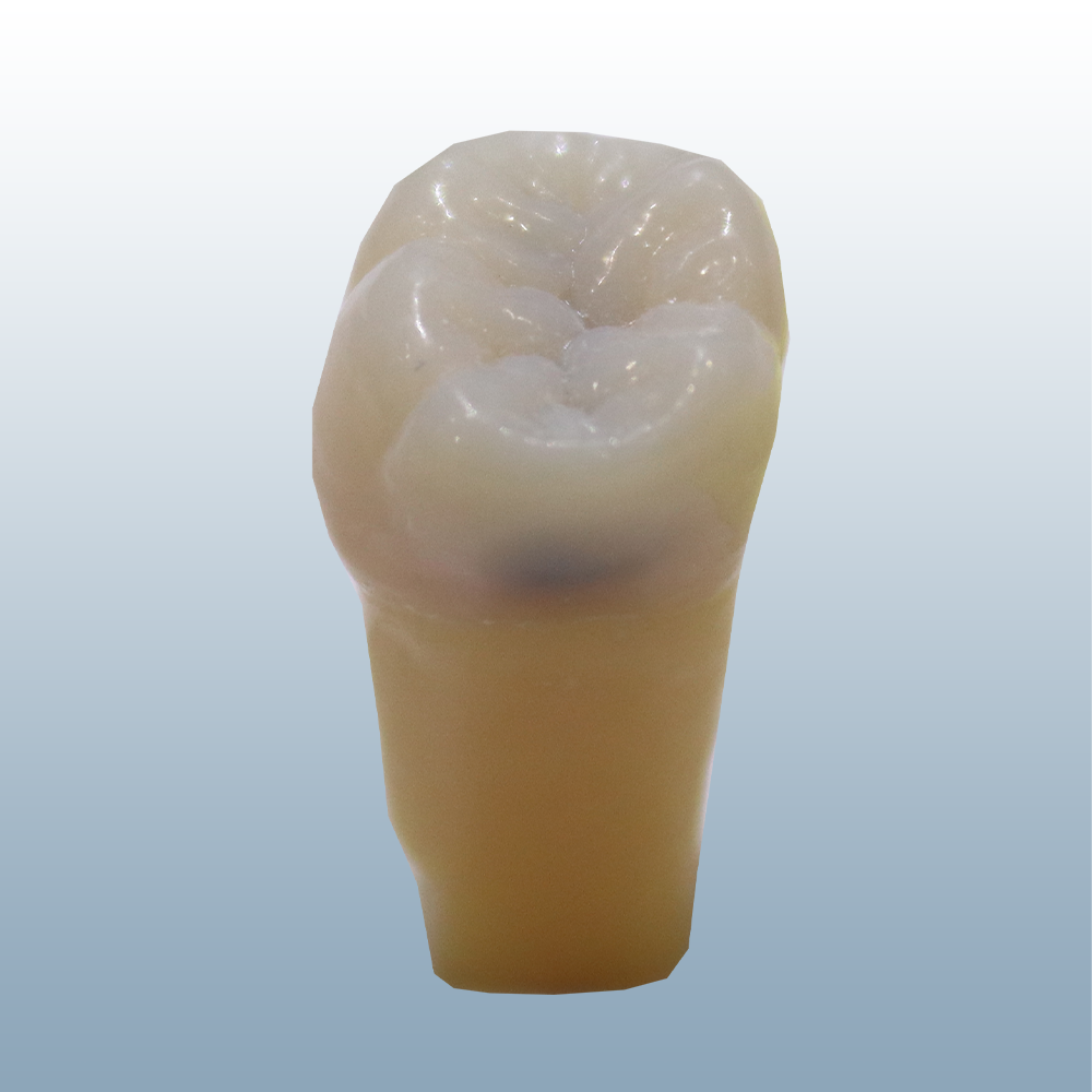 Caries Tooth #14 MO product image