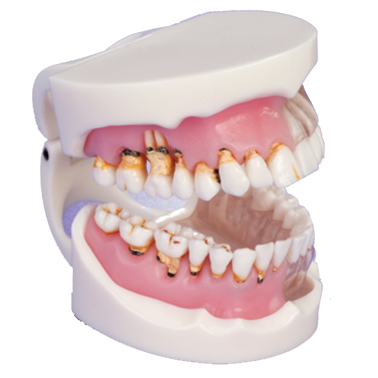 Pathological Gingivitis Model product image