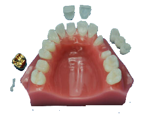 K-2 Crown and Bridge Model product image
