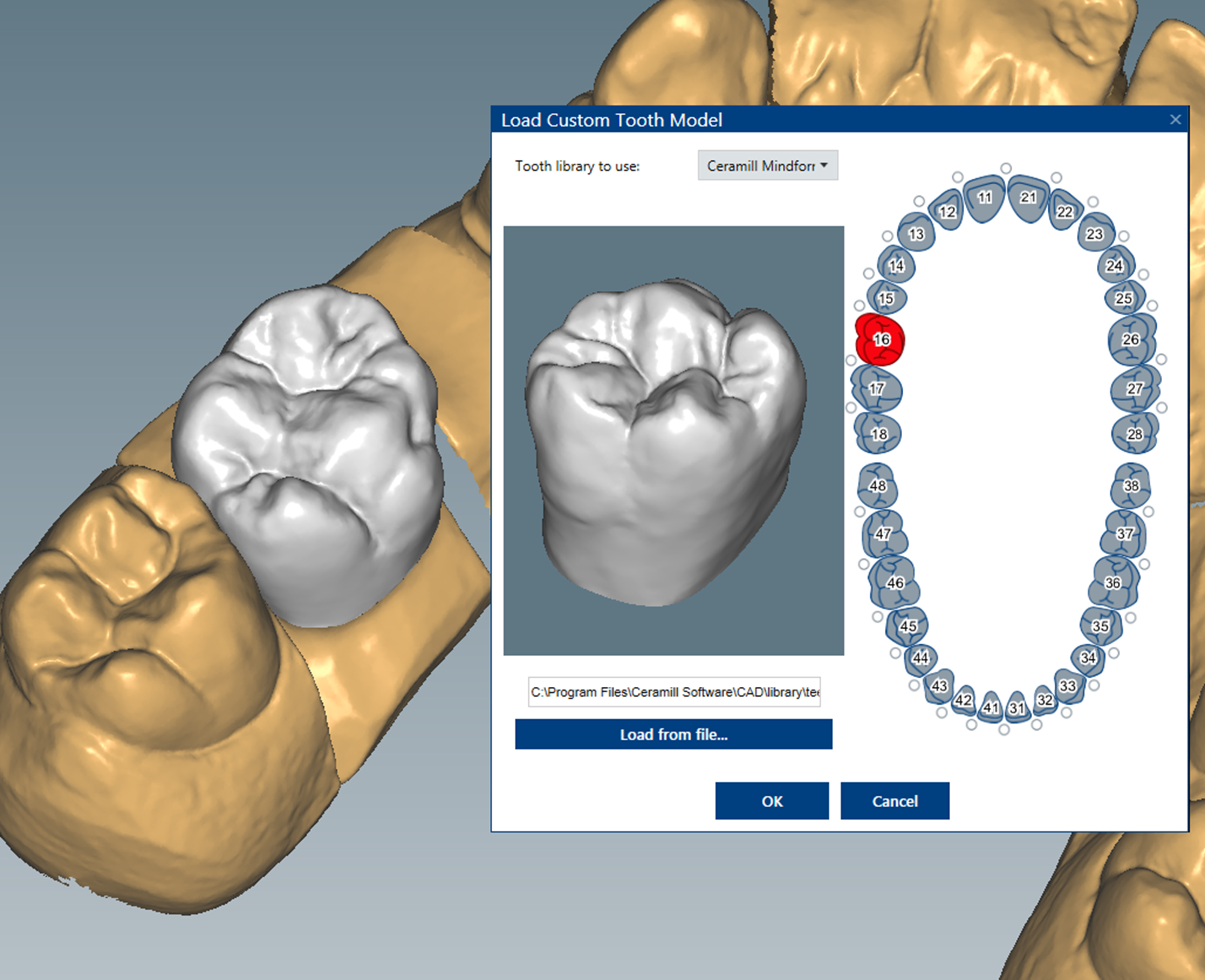 ceramill® Mindforms Cutback Extension product image
