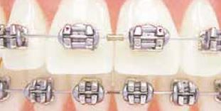 Ortho Specialties Gold Tone Crimpable Stops 2mm Pack of 500 product image