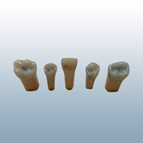 Tooth #19 Occlusal and Facial Caries product image