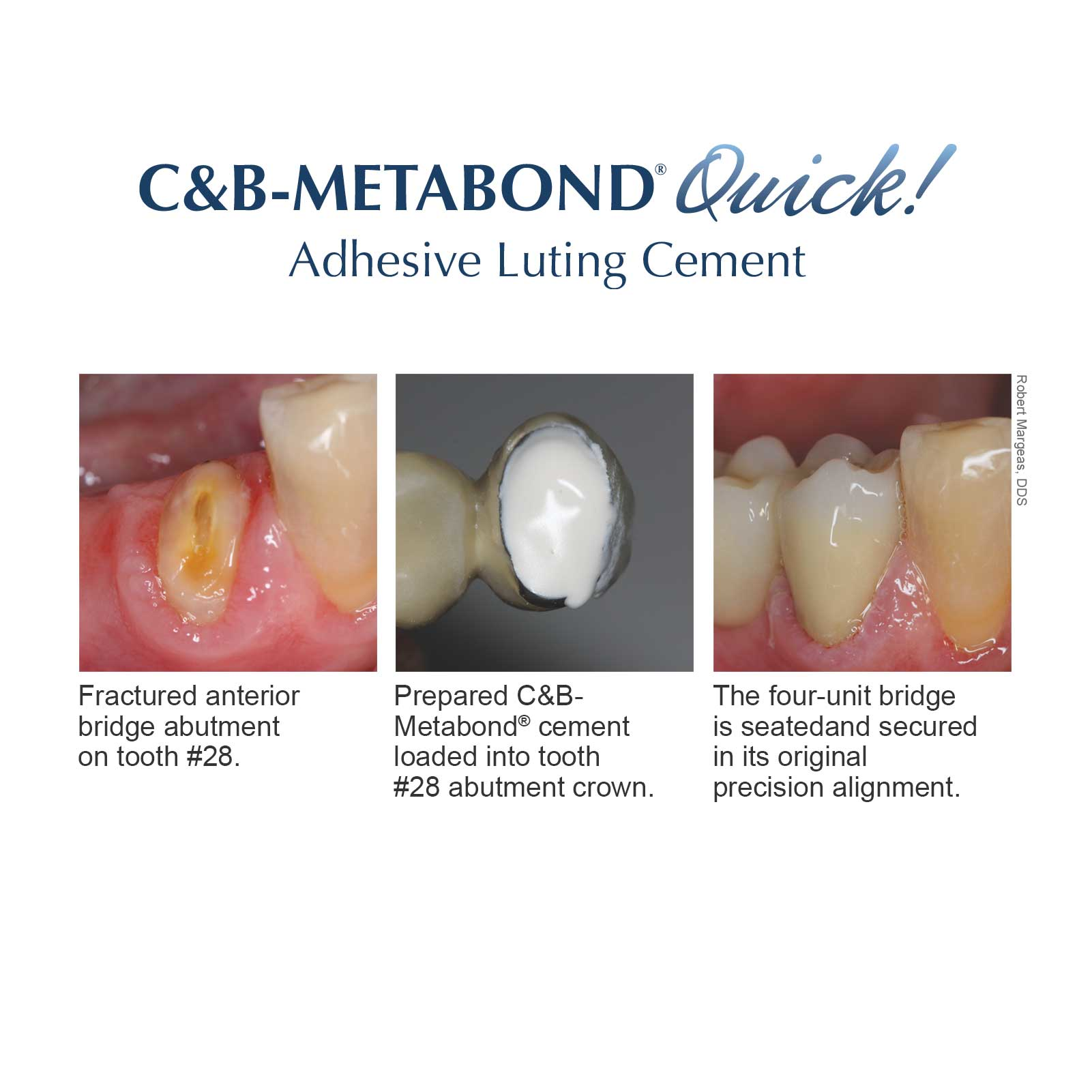 C&B Metabond Quick Adhesive Cement System Kit | Benco Dental